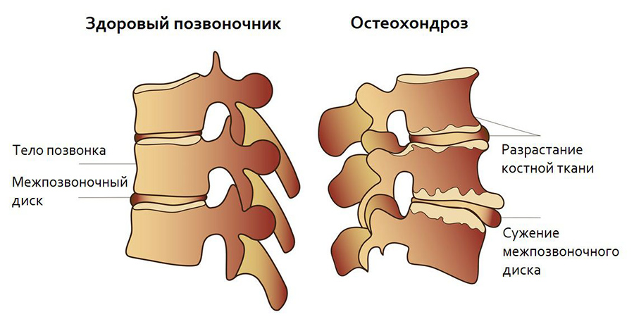 Лечение остеохондроза в Казани – шейный остеохондроз, цены, услуги в клинике